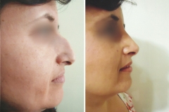 riniplastia-1