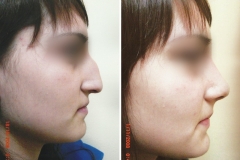riniplastia-3