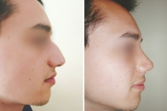 riniplastia-4
